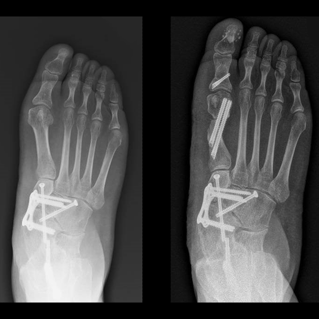 Scans show a patient’s foot before and after minimally invasive surgery to correct a bunion.